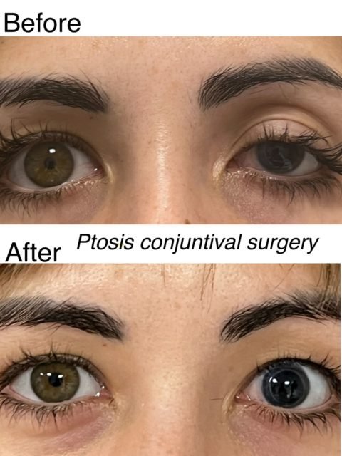 Cirugía oculoplástica 10 10