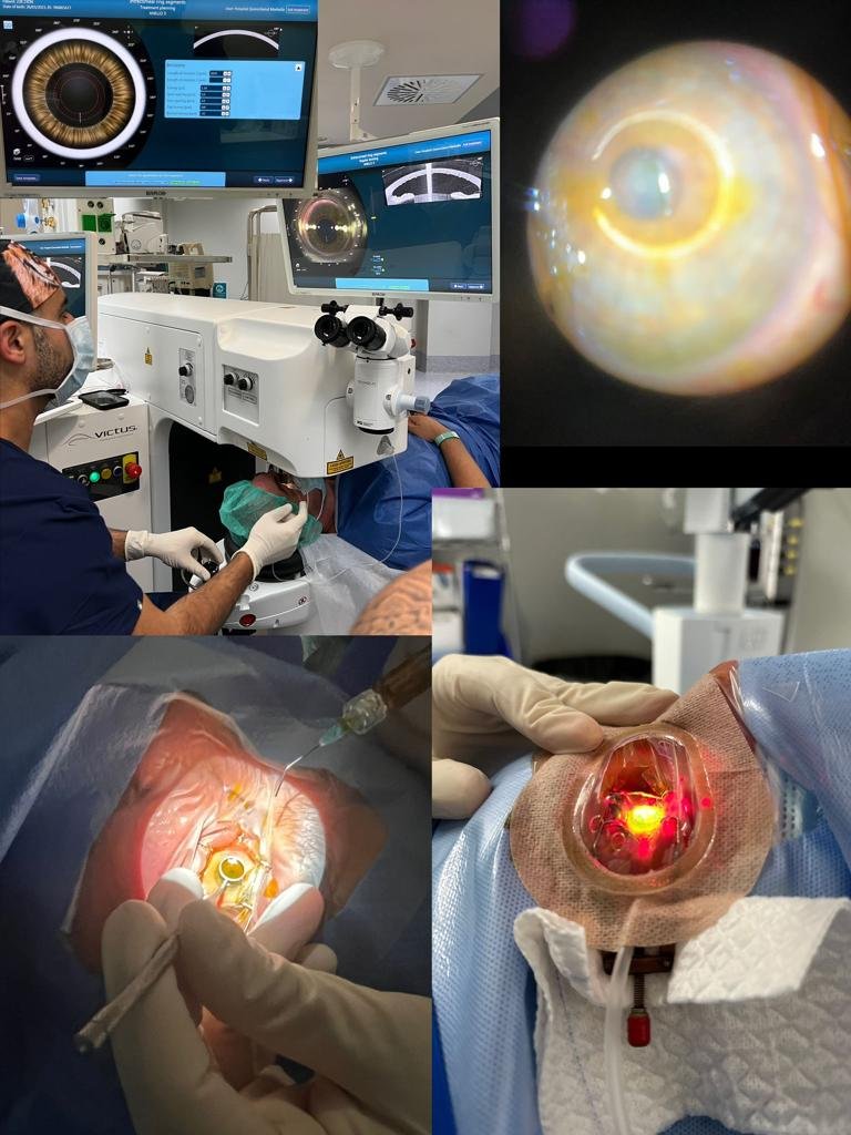 Avances en el tratamiento del queratocono: perspectivas y soluciones innovadoras 2 Beneficios de los anillos intracorneales en el tratamiento del queratocono