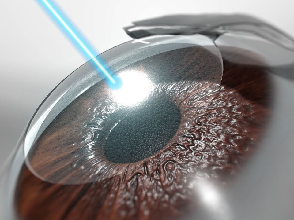 cirugia refractiva