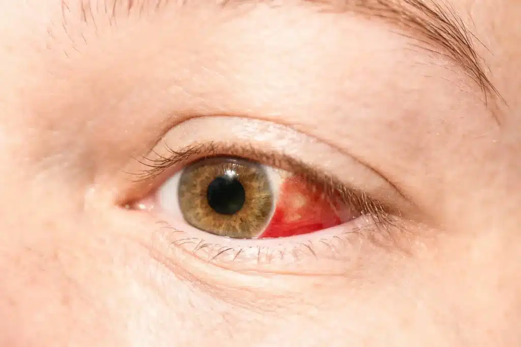derrame en el ojo