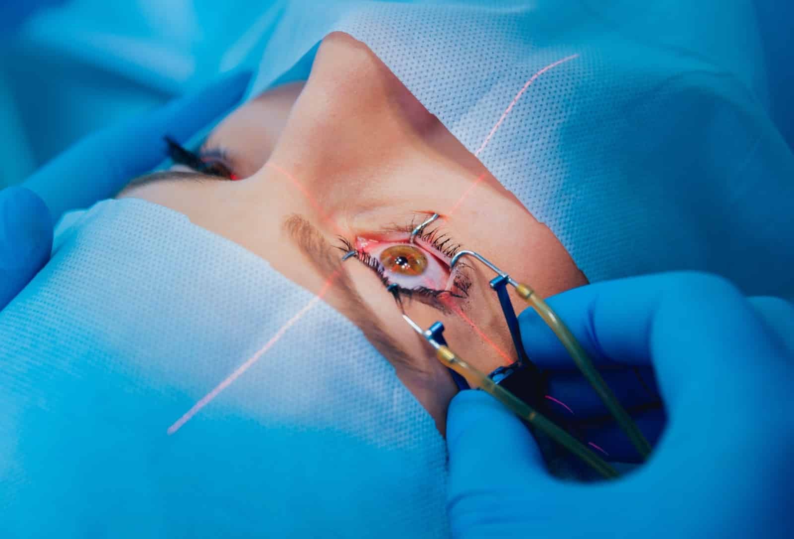 Chirurgie réfractive : qu'est-ce que c'est ?