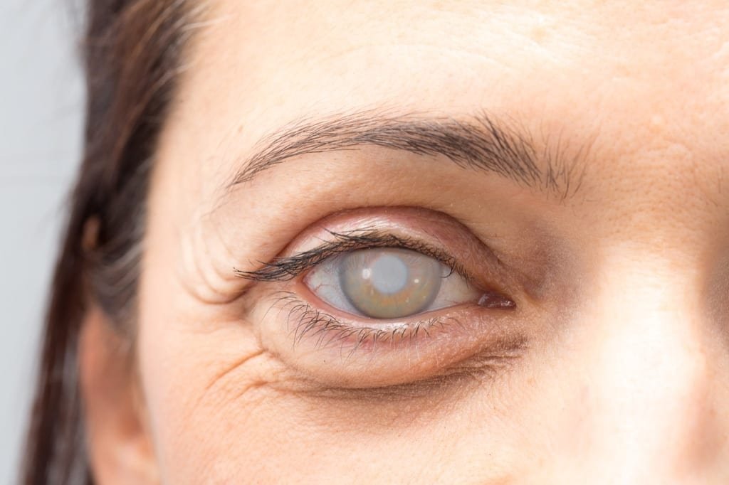 eye adult woman with cataract