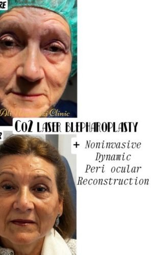 Image montrant l'avant et l'après d'une procédure de blépharoplastie au laser CO2, mettant en évidence l'amélioration de l'apparence de la peau périoculaire. Il s'agit d'un traitement non invasif et dynamique, axé sur la reconstruction de la zone autour des yeux.